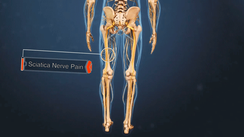 Short video of sciatica leg pain.