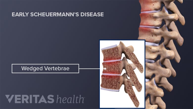 Profile view of a wedged vertebrae in early Scheuermann's disease.