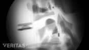 X-ray of the insertion of an artificial disc in the cervical spine