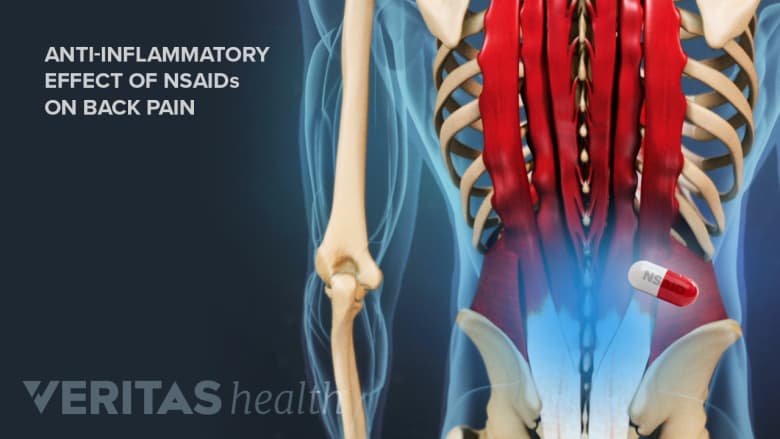 Anti-inflammatory effect of NSAIDs on back pain