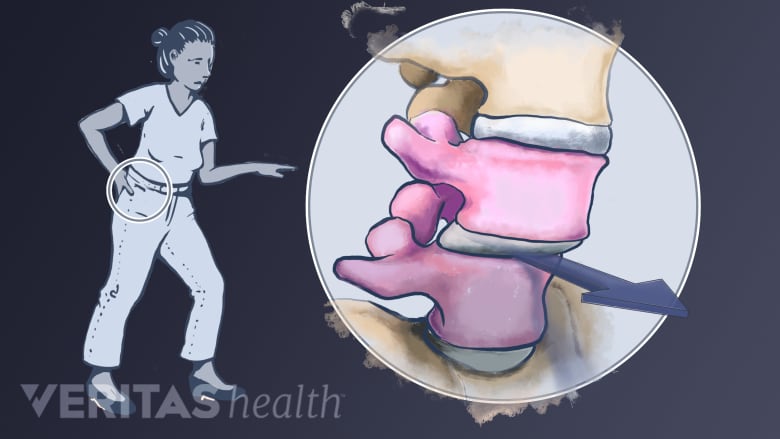 Slippage of L4 vertebra over L5 in the lower spine.