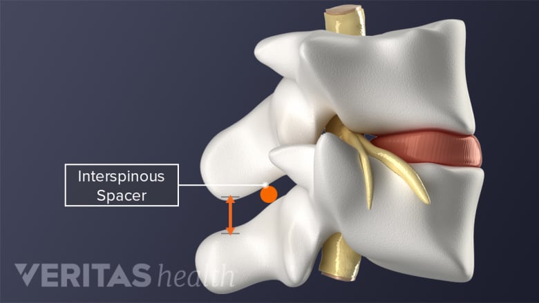 Interspinous spacer device between two lumbar vertebrae.