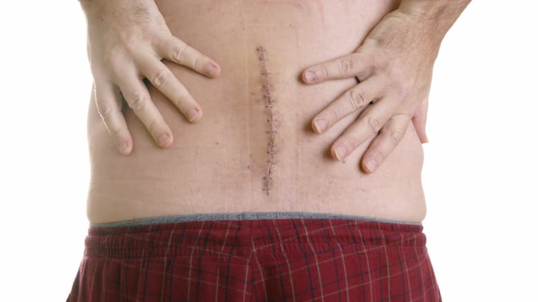 A 4-6 inch suture on a person's lower back.