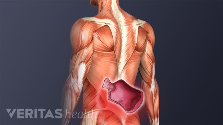 Illustrations howing posterior view of torso with a heat pack icon in the lower back.