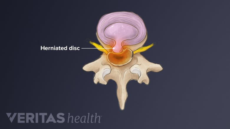 An illustration showing lumbar herniated disc.
