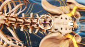 Medical illustration of the lumbar spine showing the location of a microdiscetomy