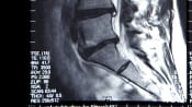 MRI scan of the lumbar spine.