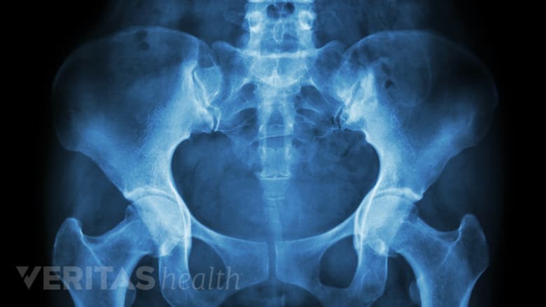 An image of female pelvis X-ray.