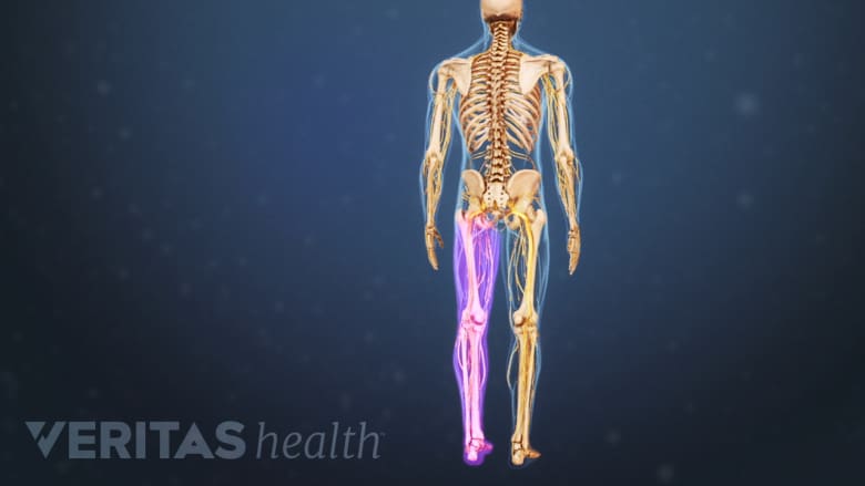 Illustration showing a skeleton with one leg highlighted in pink.