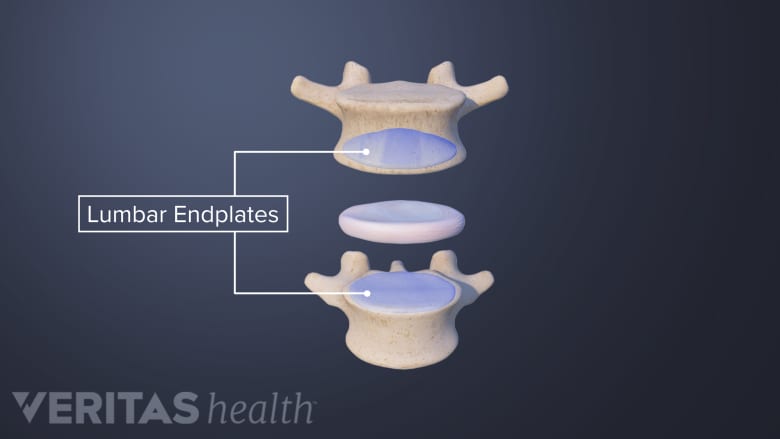 Lumbar endplates between two vertebra