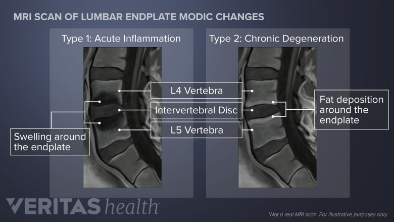 Side by side view of modic changes on an MRI scan