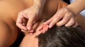 Acupuncture needles being placed in the ear