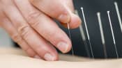 Acupuncture needles being placed on a back