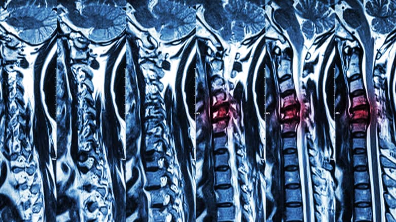 Multiple MRI views of a spine.