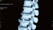 Profile view of an xray of the lumbar spine.