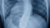 X-ray scan showing spine curvature caused by scoliosis