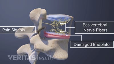 Vertebrogenenic Pain and Endplates