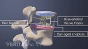 Vertebrogenic Low Back Pain and Damaged End Plate