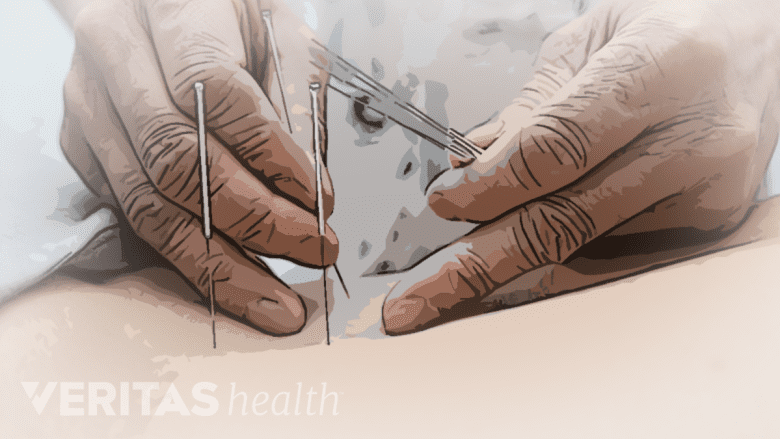 An illustration showing a therapist performing acupuncture with needles