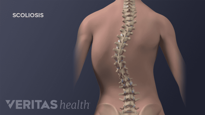 Illustration showing scoliosis.