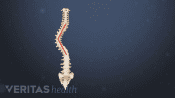 Medical illustration of an adolescent skeleton with scoliosis