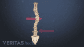 Medical illustration of an adolescent spine with scoliosis
