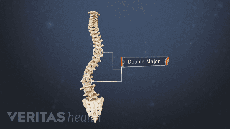 Illustration showing vertebral spine with double major curve.