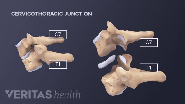 Cervicothoracic junction showing collapsed and expanded view of C7 and T1.