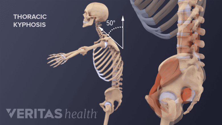 illustration of adult spine with kyphosis