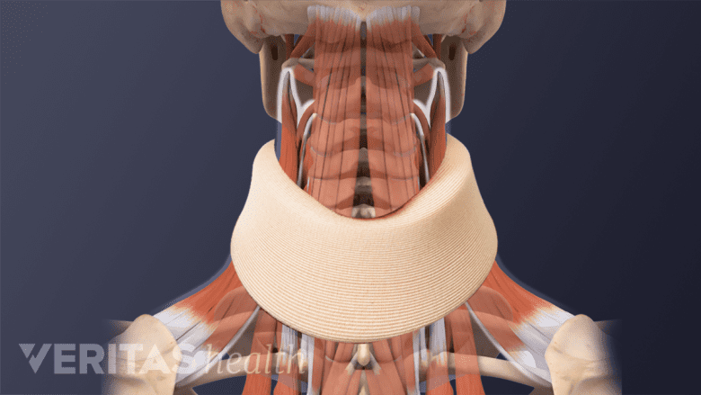 Illustration showing neck with neck brace.