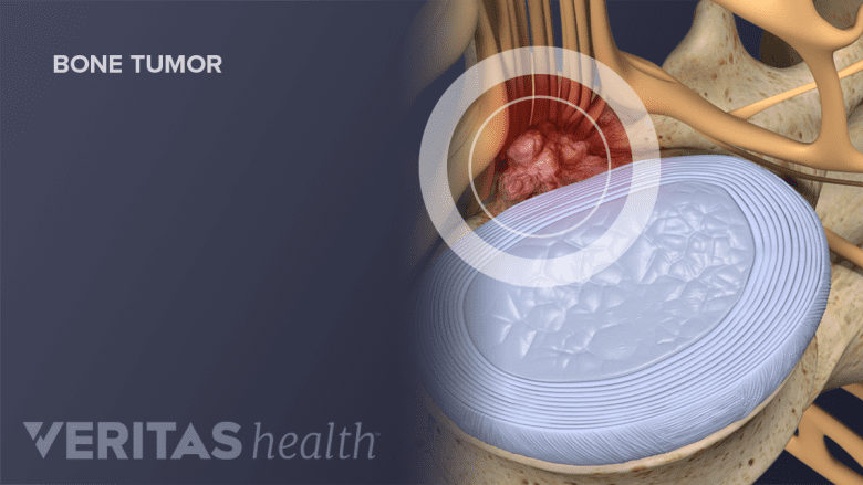 Image showing a spinal tumor near the spinal cord.