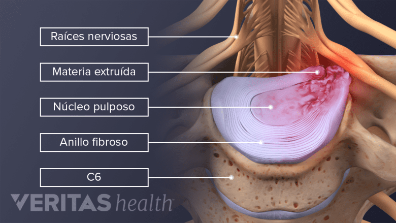 Los componentes de una hernia discal cervical.