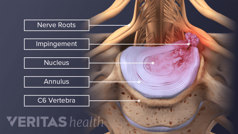 Illustration showing cervical herniated disc.