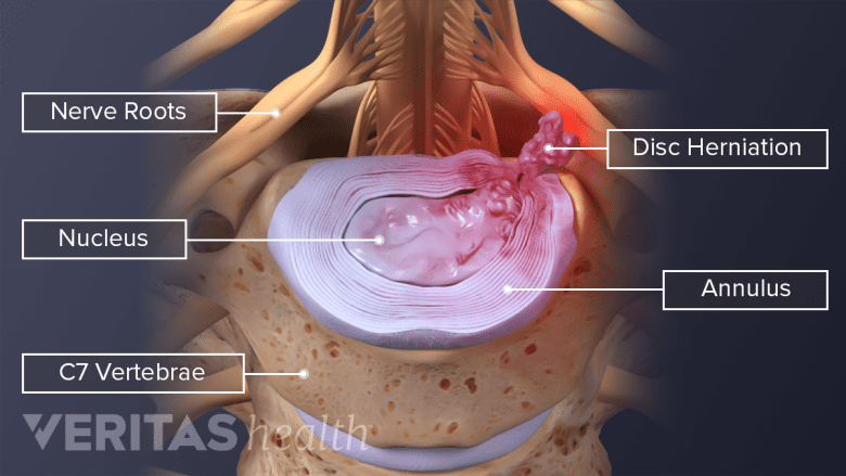 Illustration showing c7 vertebra showing herniation with nerve root inflammation.