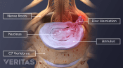 Illustration of C6-C7 herniation and nerve impingement. Nerve roots, nucleus, annulus, material impinges onthe nerve and the 7th cervical vertebra are labeled.