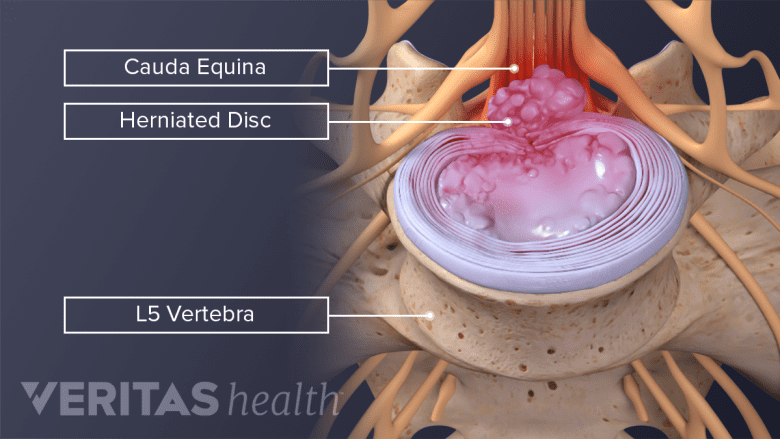 A severely herniated disc pressing on the cauda equina nerves in the lower spine.