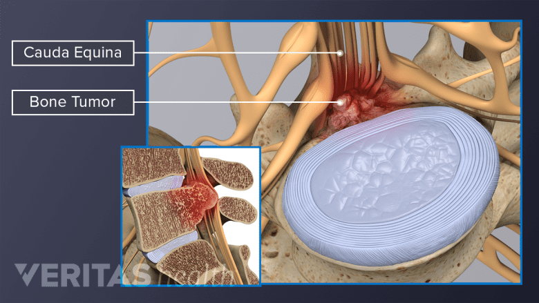 Bone tumor compressing the cauda equina nerves in the lower spine.