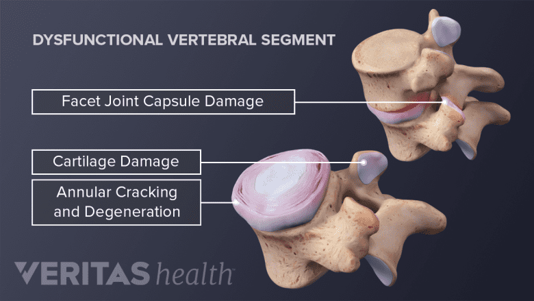 An illustration showing vertebral segment showing degeneration.
