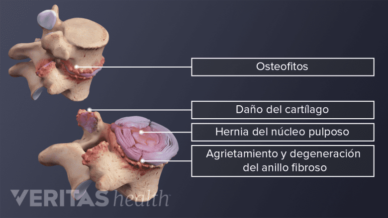 Degeneración vertebral y discal en la columna vertebral.