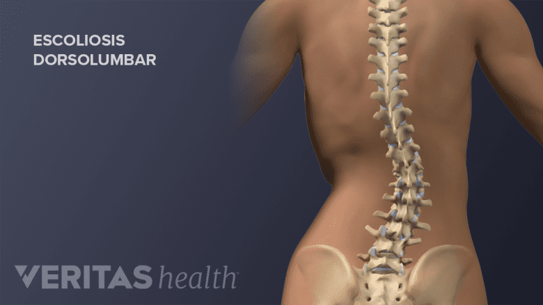 La escoliosis dorsolumbar.