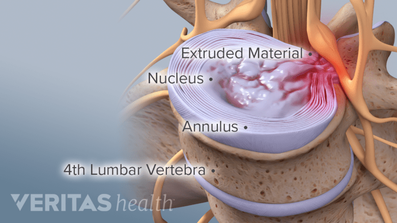 Illustration showing extrution in the l3 l4 segment.