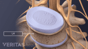 Medical illustration of a health L4 vertebra, the nerve root, disc nucleus and annulus are also labeled.