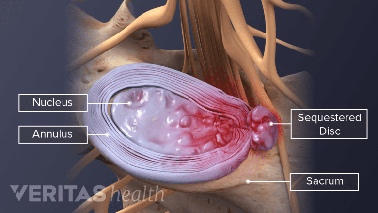 A herniated spinal disc in the L5-S1 spinal segment.