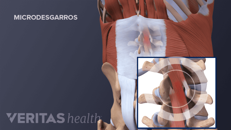 Un microdesgarro en el músculo de la espalda baja.