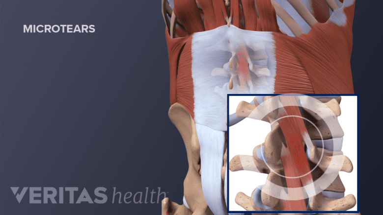 An illustration showing muscle pull in the lower back.