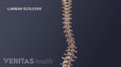 Medical illustration showing the lumbar scoliosis curve in an adult spine