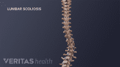 Medical illustration showing the lumbar scoliosis curve in an adult spine