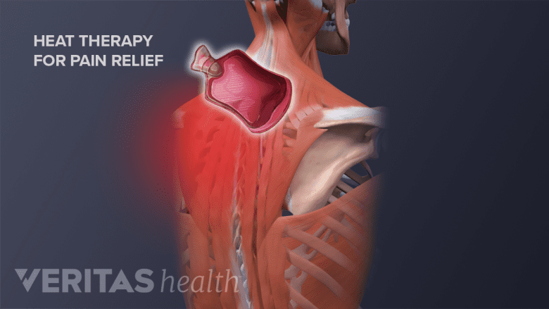 Muscles of back with a hot pack near neck.