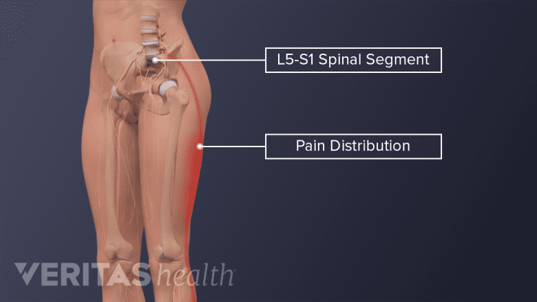 Anterior view image of lower body and skeleton with L5-S1 segment and its pain radiculopathy labeled.