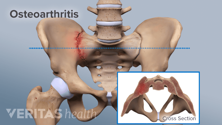 Illustration showing pelvis with SI joint in red and an inset showing cross section of pelvic bone.